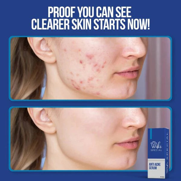 Wiki Special Cream & Acne Serum - Mega Deal 3